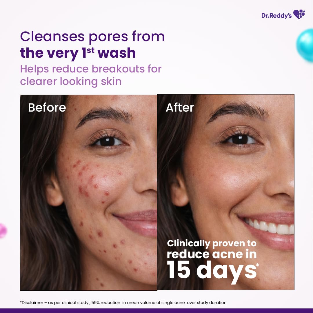 Venusia Acne Facewash | Sebum Control & Hydrating Formula | Clears Acne-marks | Enriched with encapsulated Salicylic Acid, Glycolic Acid, Ceramide - Oat - HA Complex | Oily & Acne-Prone Skin | 75g ( Pack of 2 )
